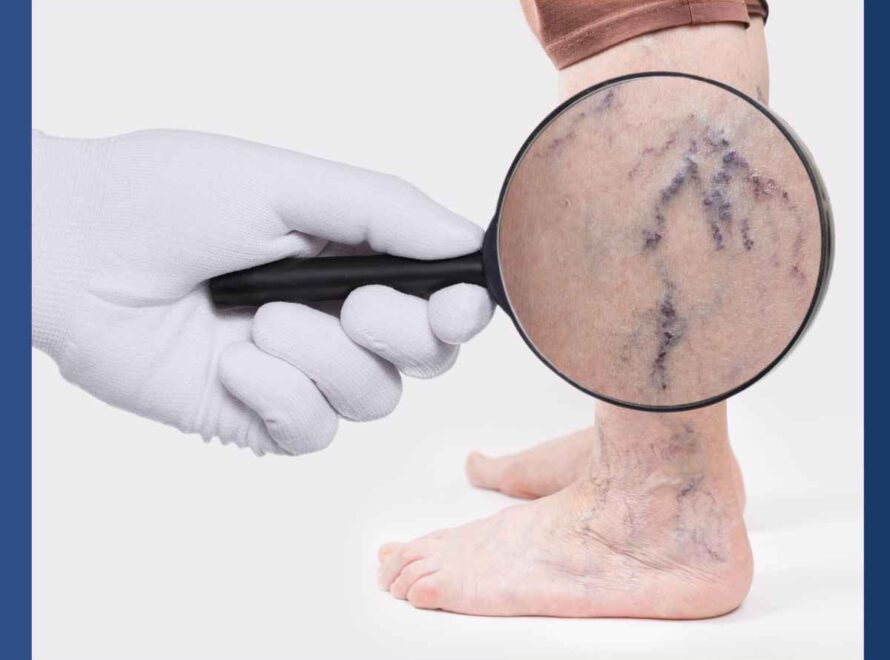 magnified view of varicose veins