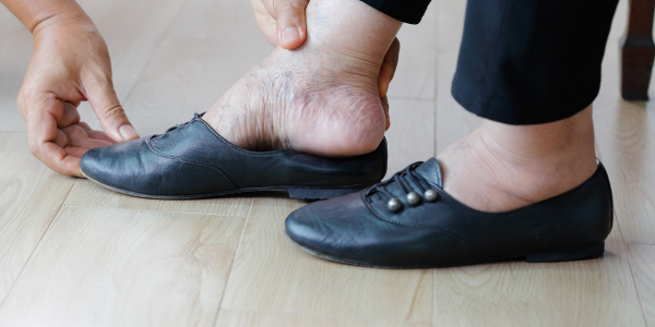 woman with swollen feet putting on shoes