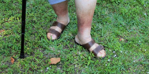 woman walking in grass with skin discoloration on legs