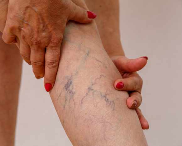 woman touch leg with visible spider veins