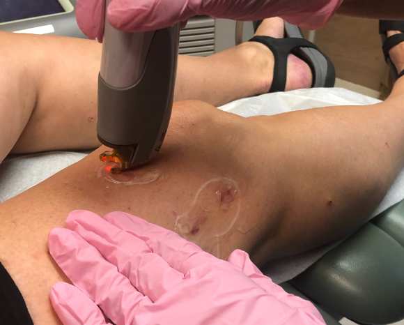 patient with spider veins having laser treatment 