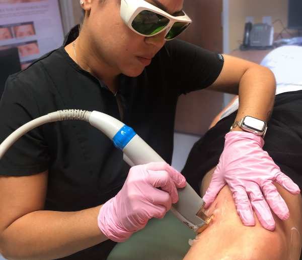 nurse practioner using laser on patients spider veins