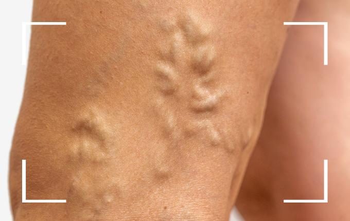 bulging varicose veins on leg of patient