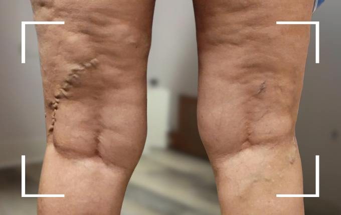 patient with varicose veins on back of legs