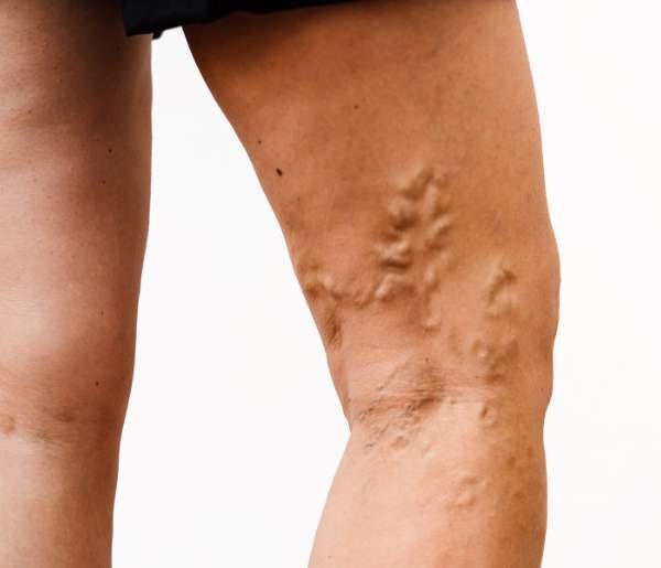 legs with bulging veins