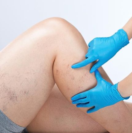 leg with spider veins being examined