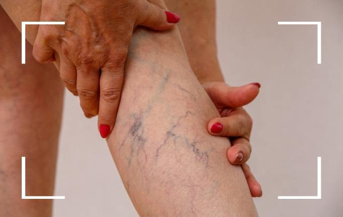 spider veins on legs